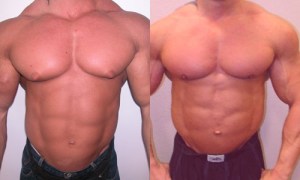 Gynecomastia_in_Bodybuilder